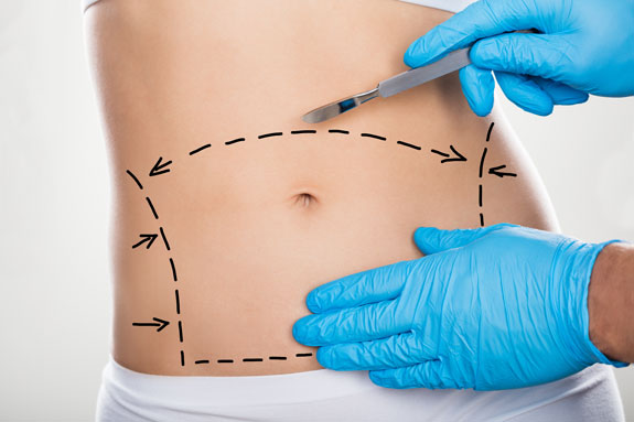 Abdominoplastik Pfaffenhofen